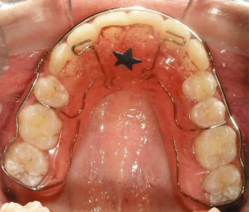 Fig. 31 Retenedor circunferencial sup.