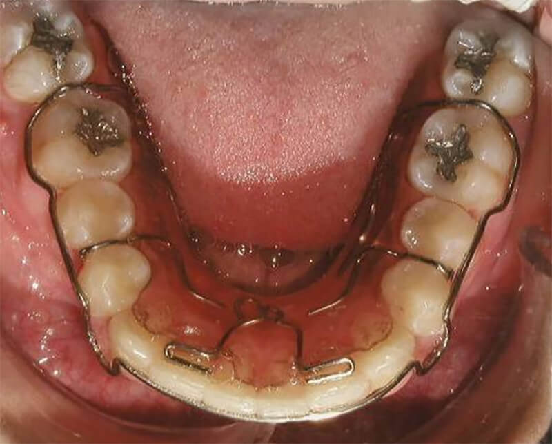 Fig. 32 Retenedor circunferencial inf.