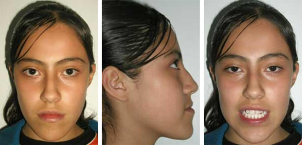 Foto 1 frente / Foto 2 de perfil, donde se observa un perfil cóncavo / Foto 3 sonrisa