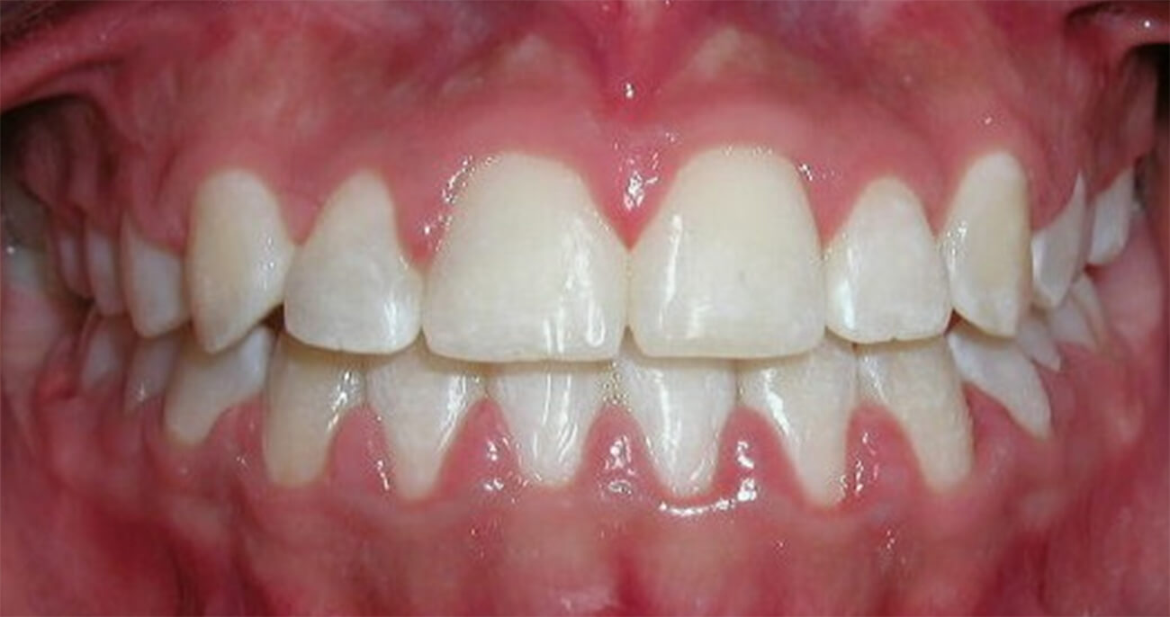 Foto 14 Intraoral frente
