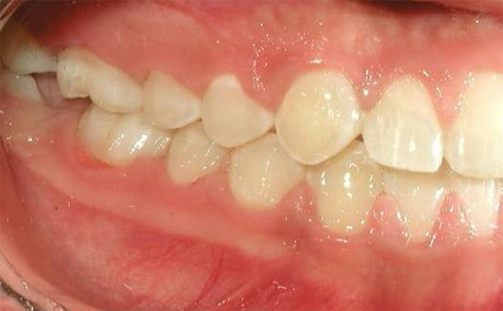Foto 15. Intraoral derecha