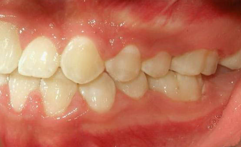 Foto 16 intraoral izquierda