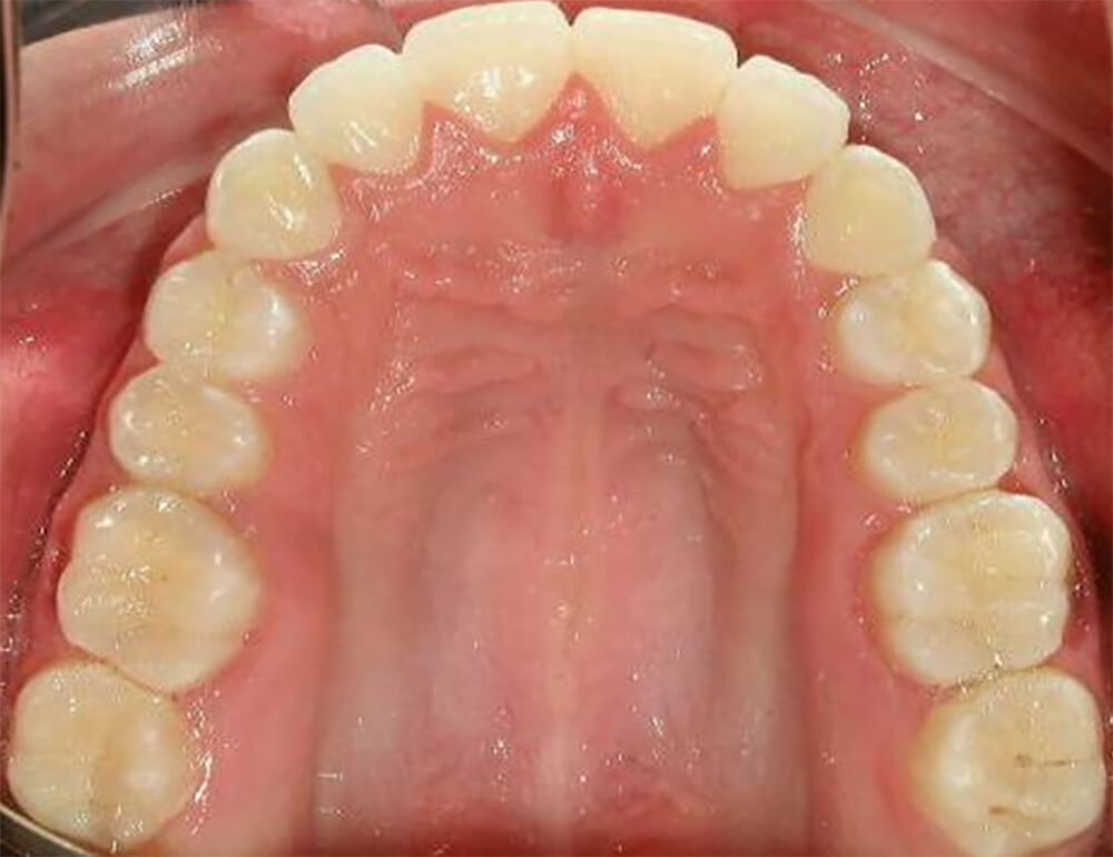 Foto 17. Intraoral Oclusal Superior