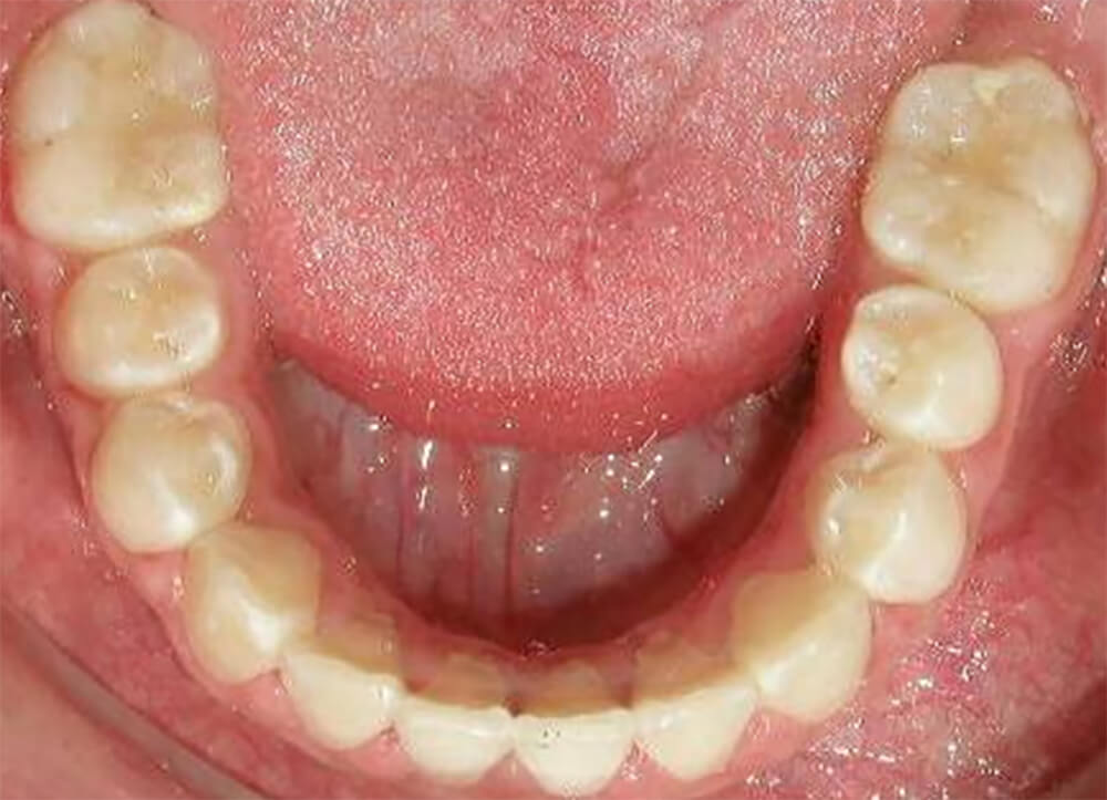 Foto 18. Intaroral Oclusal Inferior