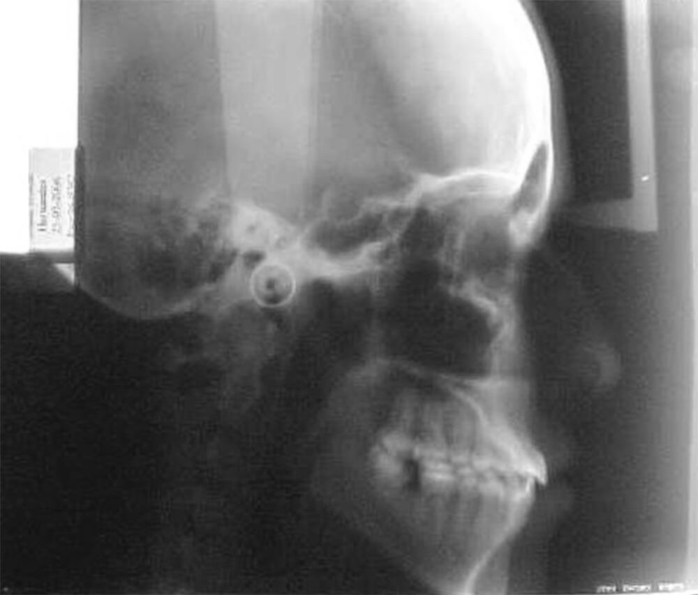 Foto. 19 Radiografía Lateral De Cráneo