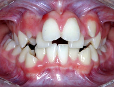 Fig.4 Foto Intraoral de frente de inicio