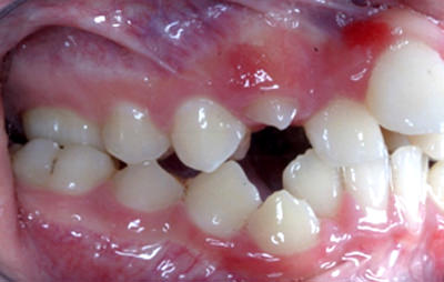 Fig5 Lateral derecha inicial