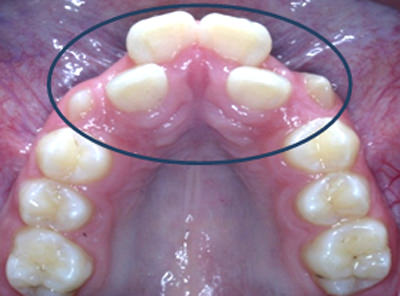 Fig 7 Foto Oclusal Superior