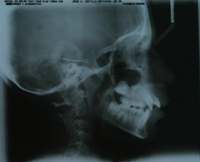 Fig 9 Radiografía lateral de cráneo