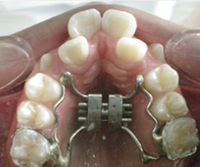 Fig.11 Foto de Intraoral de Frente