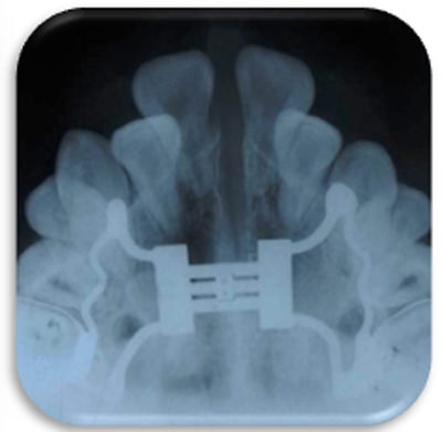Fig.12 Radiografía oclusal con Hyrax