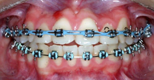 Fig.13 Intraoral de frente