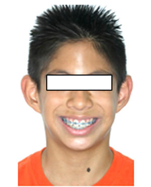Fig.14 Foto de Sonrisa