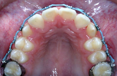 Fig 17 Oclusal superior