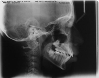 Fig.25 Radiografía lateral de cráneo