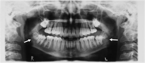Fig.26 Radiografía panorámica final