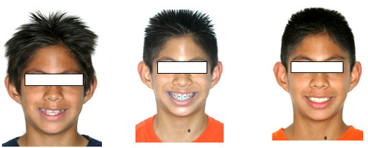 Fig.27 Comparaciones foto de sonrisa al inicio, durante y final del tratamiento