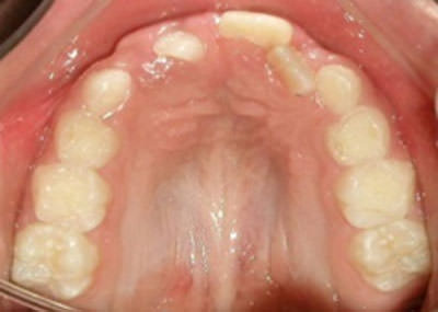 Figura 6 Oclusal superior