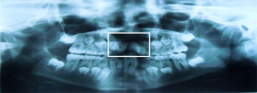 Figura 9 Radiografía panorámica de inicio