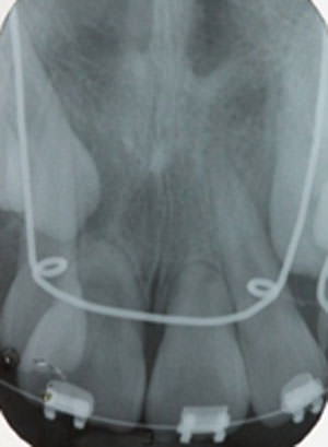Figura 10 Radiografía periapical de antero superiores inicio