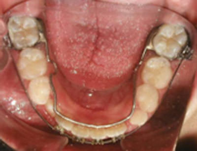 figura 14 Oclusal inferior