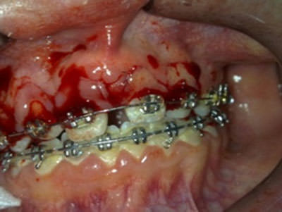 Figura 15 Gingivectomia