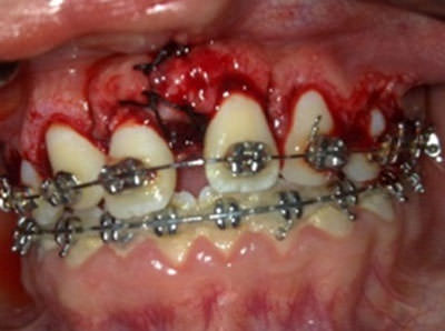 Figura 16 Gingivectomia