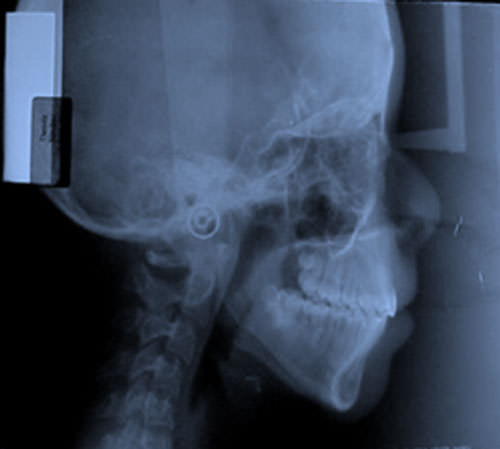 Figura 23 Radiografía lateral de cráneo
