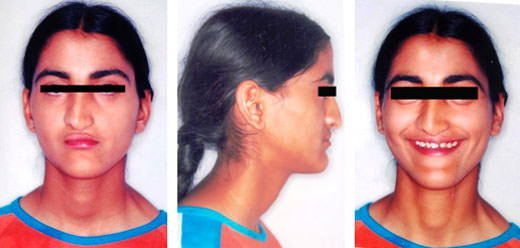 Fig:1 Pre treatment extra oral photographs