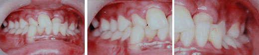 Fig:2 Pre treatment intra oral photographs