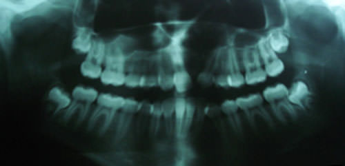 Fig:3 Pre treatment OPG