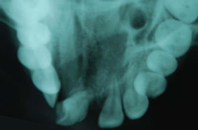 Fig:4 Pre treatment occlusal view