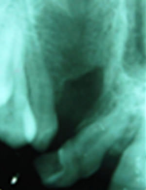 Fig:5 Pre treatment IOPA
