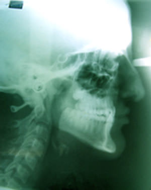 Fig:6 Pre treatment lateral cephalogram