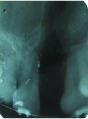 Fig:7 Post alveolar bone grafting IOPA