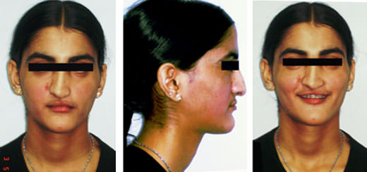 Fig:8 Post treatment extra oral photographs