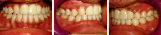 Fig:9 Post treatment intra oral photographs