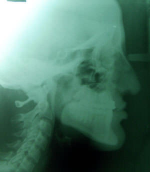 Fig:10 Post treatment cephalogram