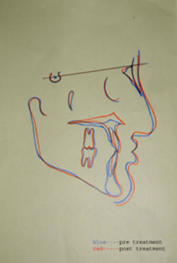 Fig:11 Cephalometric superimposition