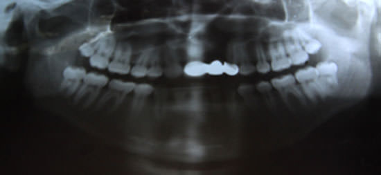 Fig:12 Post treatment OPG