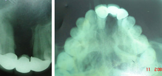 Fig:13 2 years post treatment IOPA & Occlusal radiograph showing resorption of bone graft