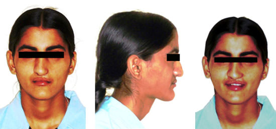 Fig:14 2 years Post treatment extra oral photographs