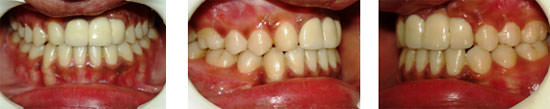 Fig:15 2 years post retention intra oral photographs