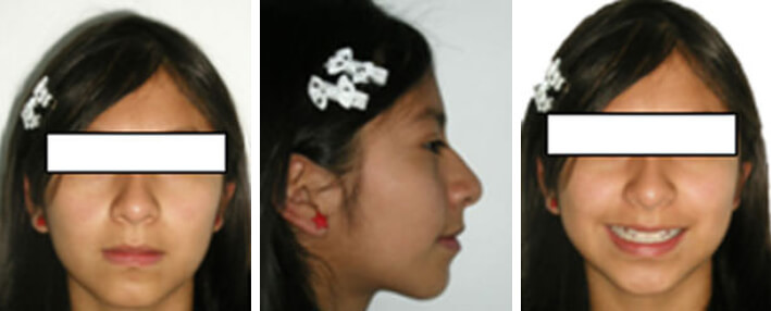 Fig.1 Extaoral de frente Fig.2 De perfil Fig 3 Frente de Sonrisa