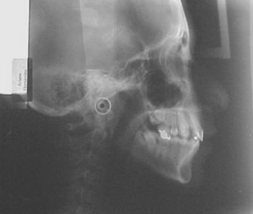 Figura 9 Radiografía lateral de cráneo