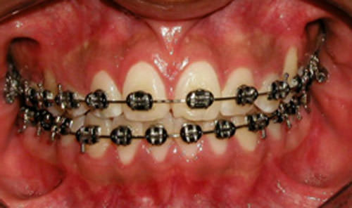 Figura 11 Intraoral de Frente de progreso