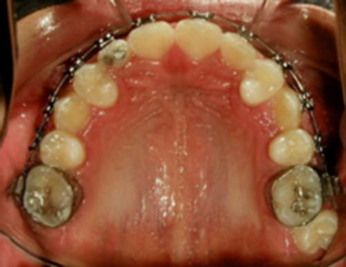 Figura 13 Oclusal Superior de progreso
