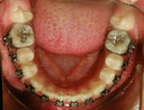 Figura 14 Oclusal Inferior de progreso