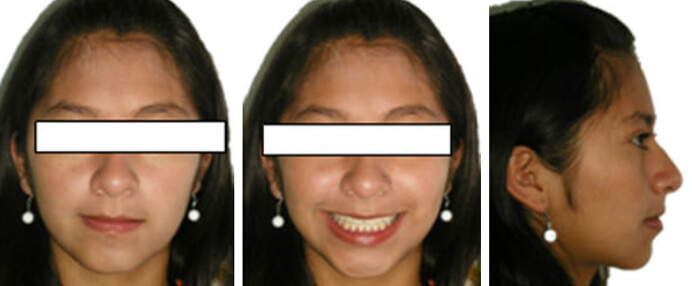 Fig.15 Extaoral de frente Fig.16 Foto de Sonrisa Fig 17 Paciente de perfil