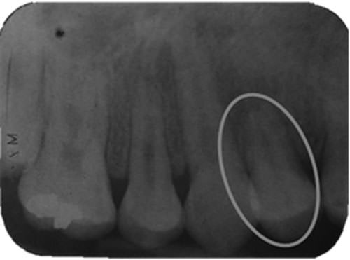 Figura 20 Rx. periapical derecha